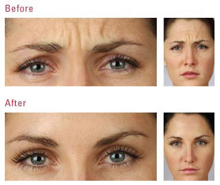 BOTOX Injections Miami Beach, Botox Offers South Beach, Botox Coupons Sobe, Botox Before and After Pictures